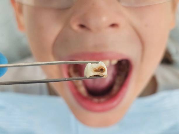 Best Emergency Dental Care for Abscessed Tooth in Derwood, MD